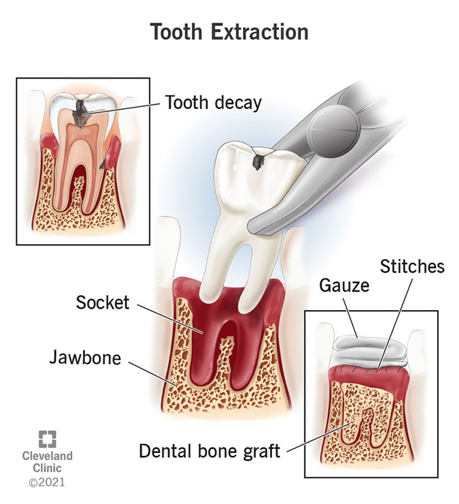 How Common Is the Need To Extract Teeth?