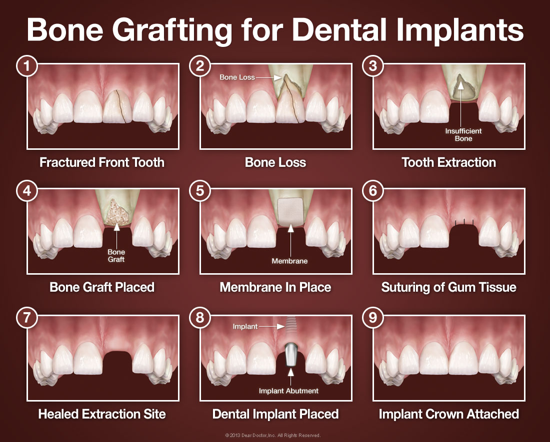 What Is A Bone Graft and When Do I Need One?