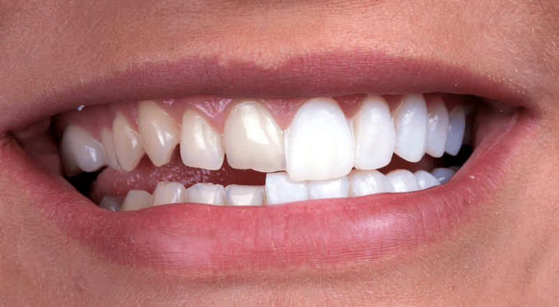 Why You Should Consider Porcelain Veneers!