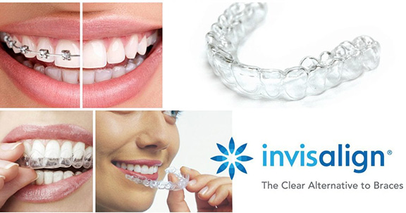 What is INVISALIGN?