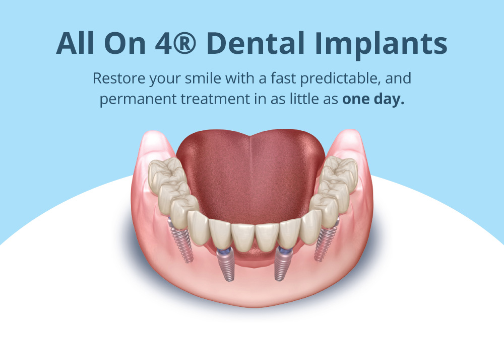 Are All-On-4® Dental Implants Right For Me?