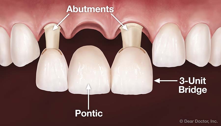 What Are Dental Bridges?