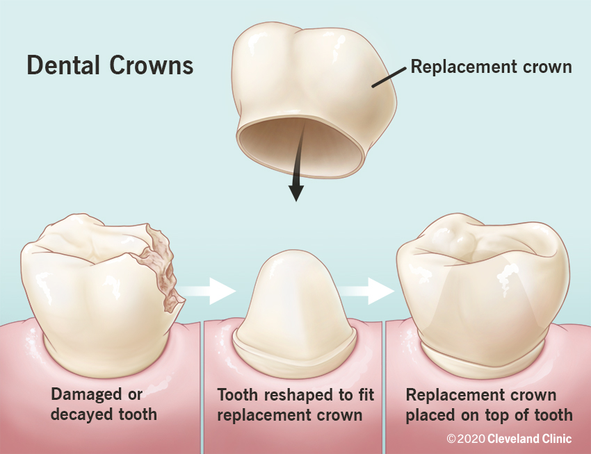 Everything You Need To Know About Dental Crowns