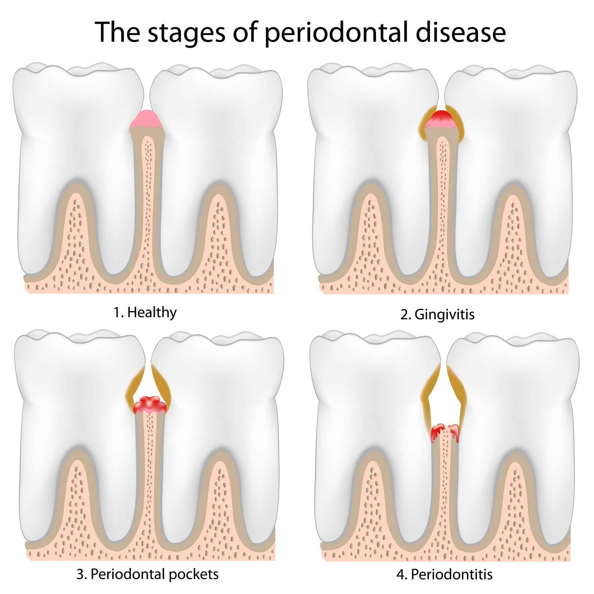 Gum Disease Treatment – How We Treat It