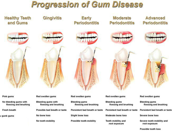 What Is Periodontal Disease and What Should You Do About It?