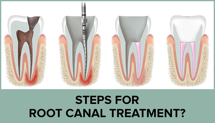 Everything You Ever Wanted To Know About Root Canals