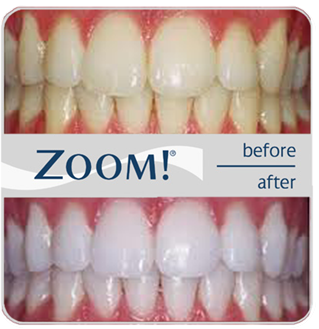 What Is ZOOM Teeth Whitening?