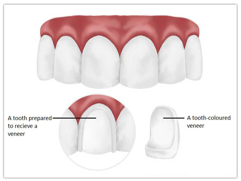 Everything You Need To Know About Veneers Vs Crowns