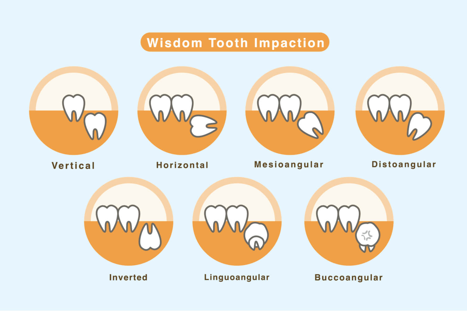 Everything You Ever Wanted To Know About Wisdom Teeth