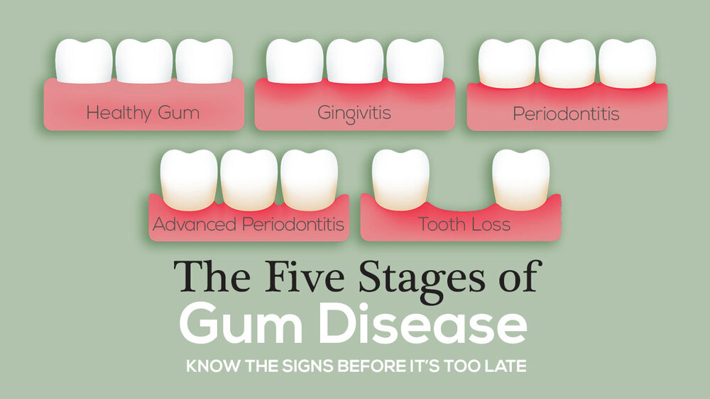 The Many Myths Of Gum Disease