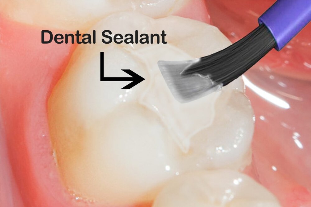 Tooth Sealants And When You May Need Them