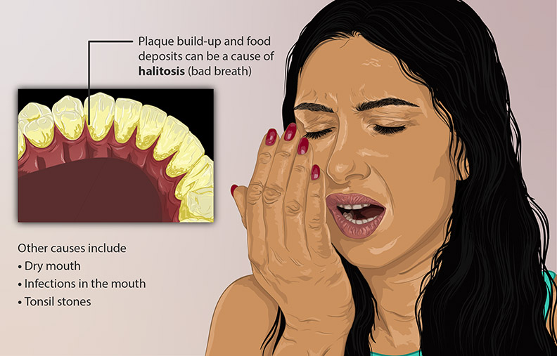 What Causes Bad Breath And How Can You Get Rid Of It?