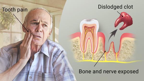 What Is Dental “Dry Socket” and When Should I Be Concerned?