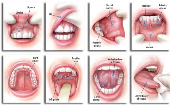 Top Risk Factors For Oral Cancer