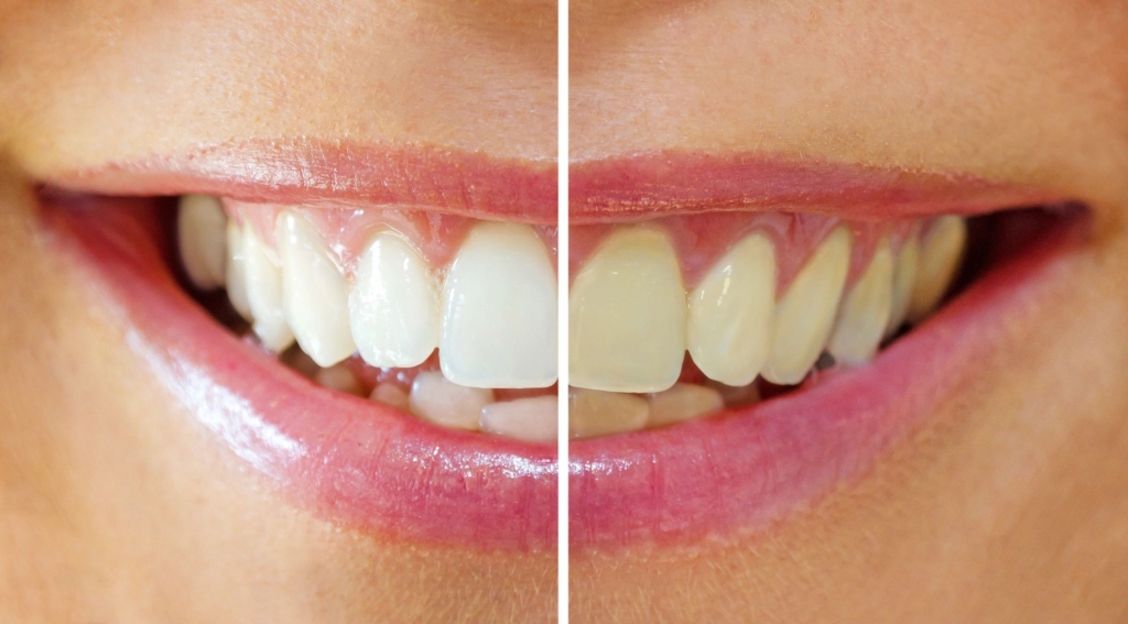 tooth whitening